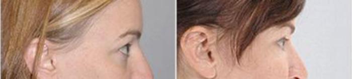 Before & After Eyelid Lift Case 217 View 3 View in Houston, TX