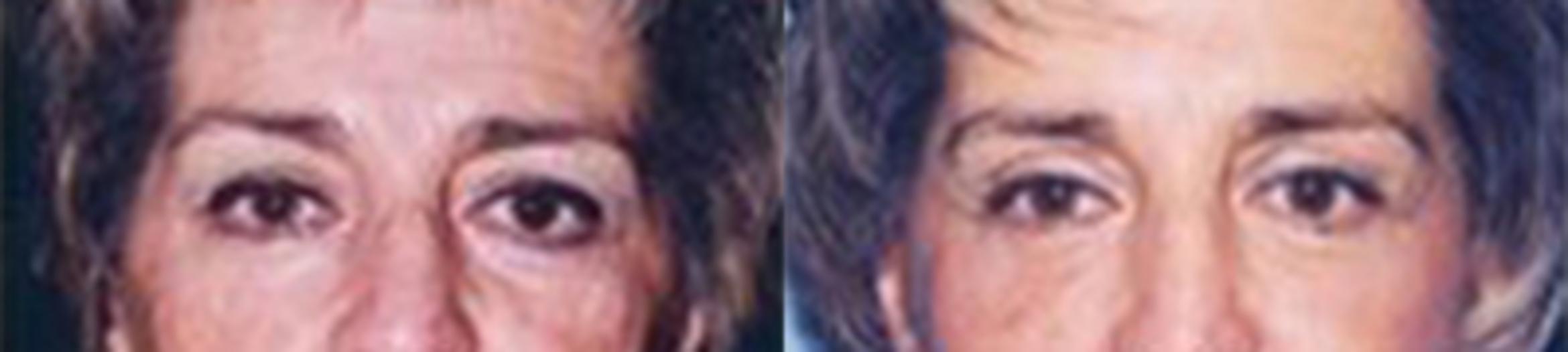 Before & After Eyelid Lift Case 58279999 View 1 View in Houston, TX