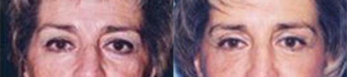 Before & After Eyelid Lift Case 58279999 View 1 View in Houston, TX