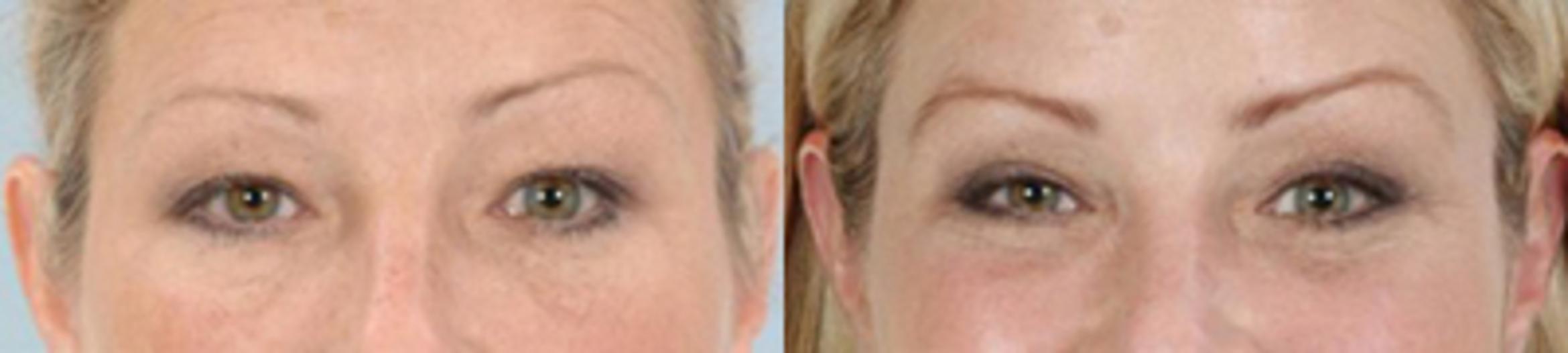 Before & After Eyelid Lift Case 5831 View 1 View in Houston, TX