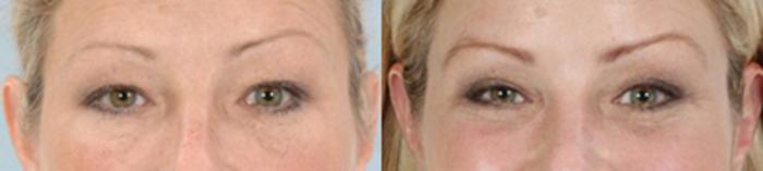 Before & After Eyelid Lift Case 5831 View 1 View in Houston, TX