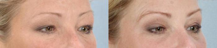 Before & After Eyelid Lift Case 5831 View 2 View in Houston, TX