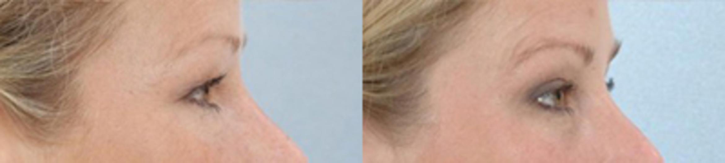 Before & After Eyelid Lift Case 5831 View 3 View in Houston, TX