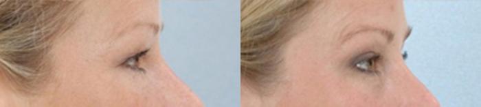 Before & After Eyelid Lift Case 5831 View 3 View in Houston, TX