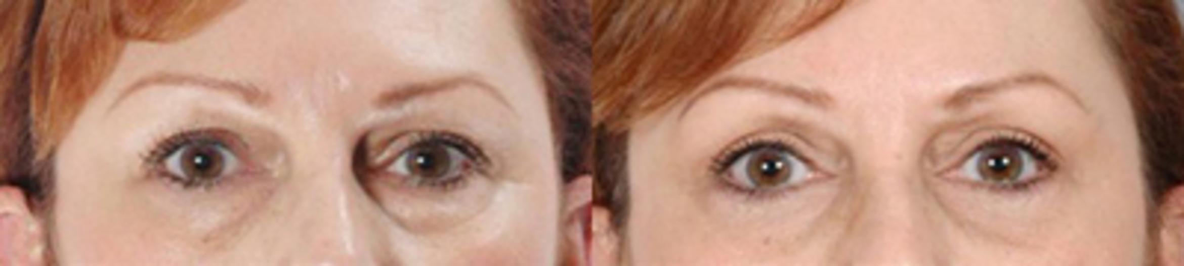 Before & After Eyelid Lift Case 5845 View 1 View in Houston, TX