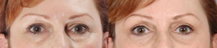 Before & After Eyelid Lift Case 5845 View 1 View in Houston, TX