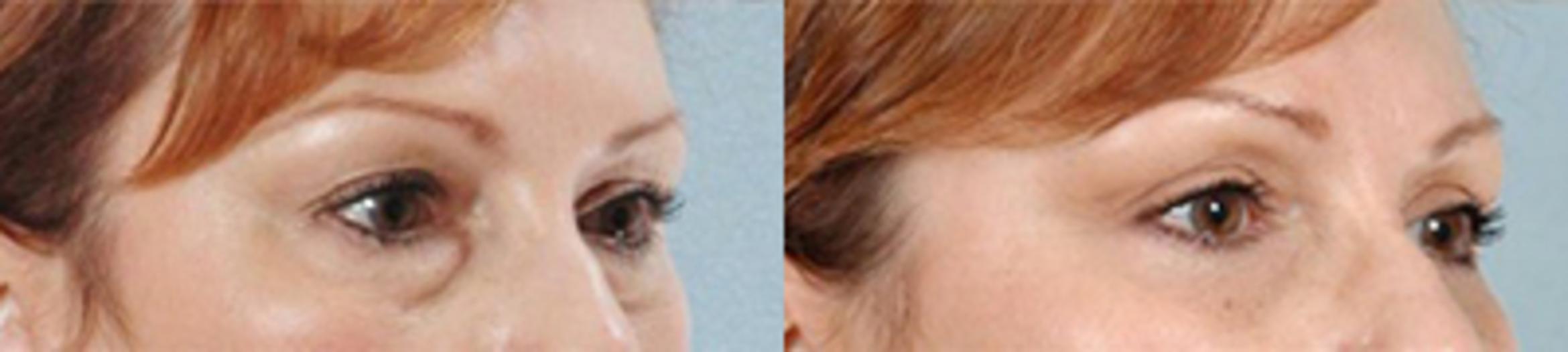 Before & After Eyelid Lift Case 5845 View 2 View in Houston, TX