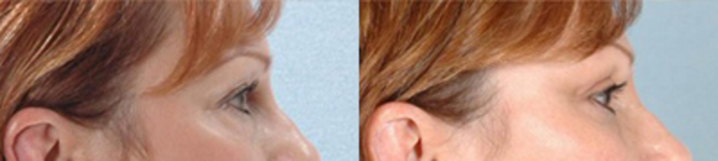Before & After Eyelid Lift Case 5845 View 3 View in Houston, TX