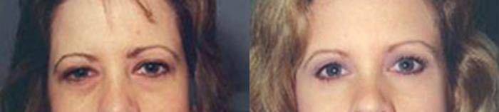 Before & After Eyelid Lift Case 5857 View 1 View in Houston, TX