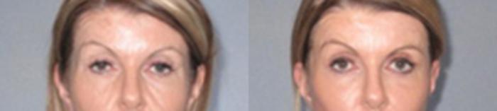Before & After Eyelid Lift Case 93889997 View 1 View in Houston, TX