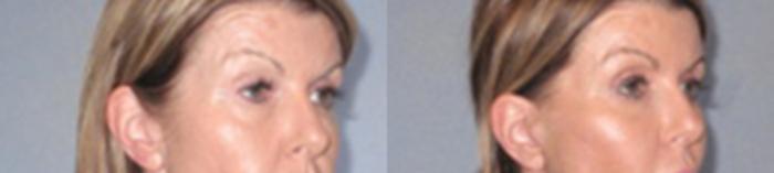 Before & After Eyelid Lift Case 93889997 View 2 View in Houston, TX