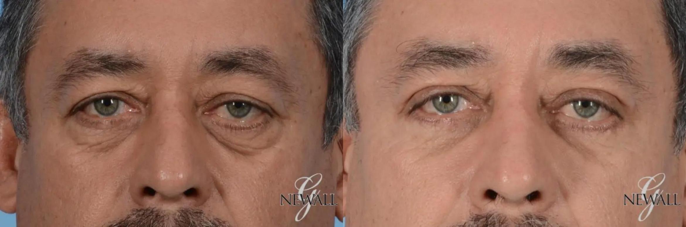 Before & After Eyelid Lift For Men Case 17025 View 1 View in Houston, TX