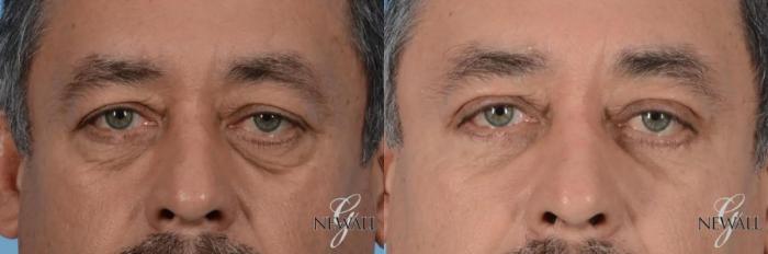 Before & After Eyelid Lift For Men Case 17025 View 1 View in Houston, TX