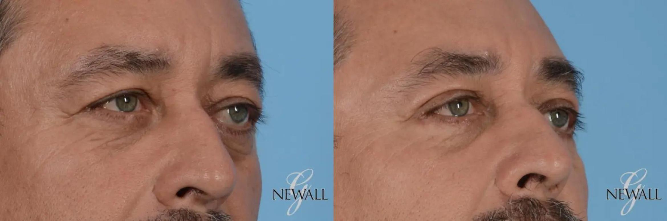 Before & After Eyelid Lift For Men Case 17025 View 2 View in Houston, TX