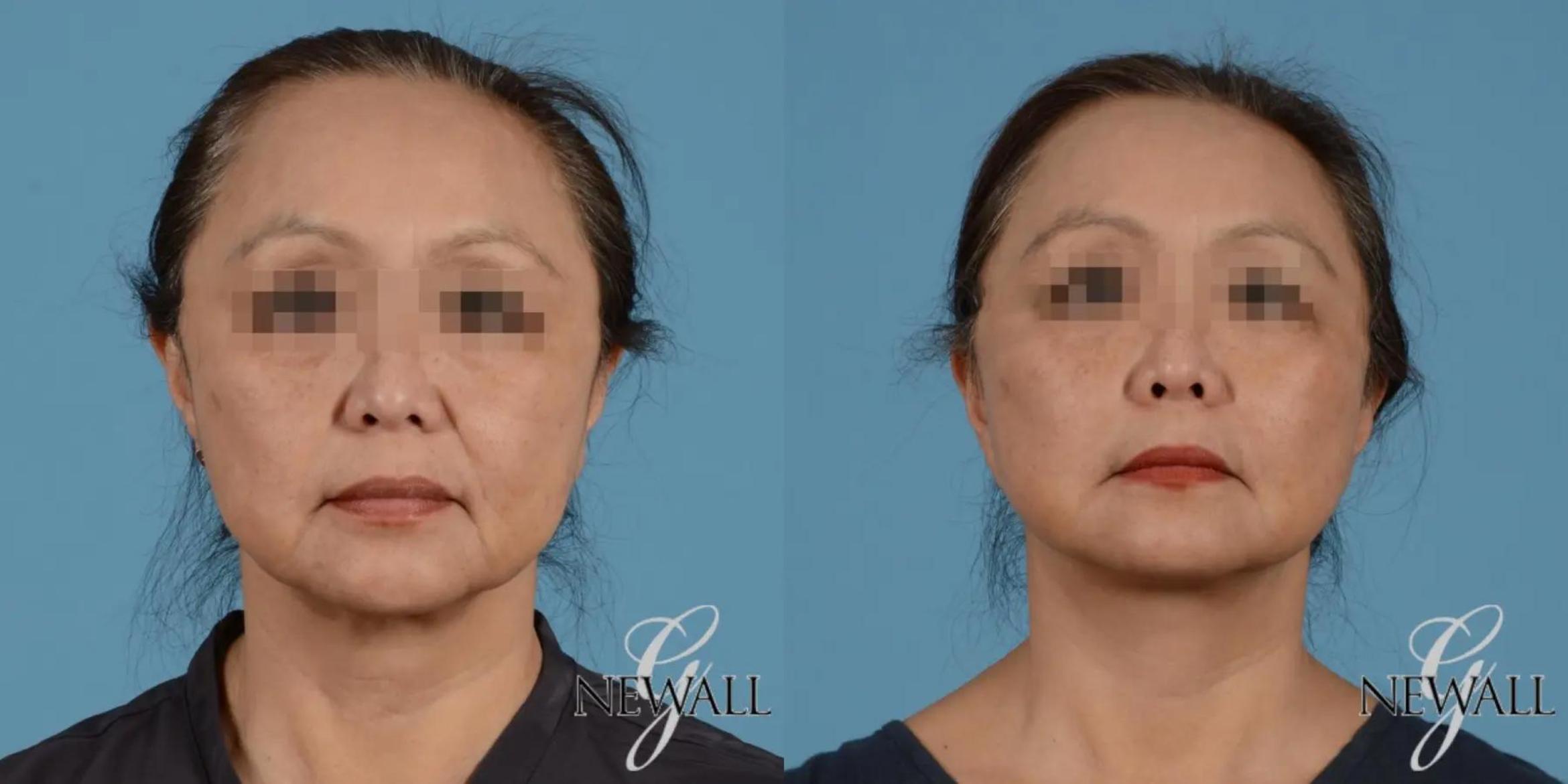 Before & After Facelift Case 17397 View 1 View in Houston, TX