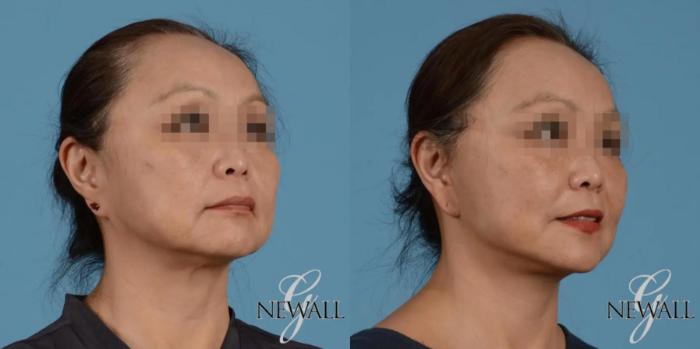 Before & After Facelift Case 17397 View 2 View in Houston, TX