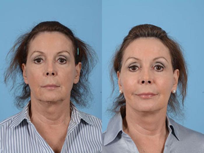 Before & After Facelift Case 18094 View 1 View in Houston, TX