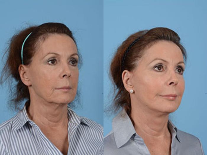 Before & After Facelift Case 18094 View 2 View in Houston, TX