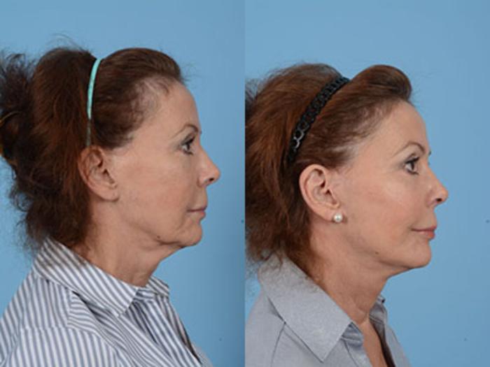 Before & After Facelift Case 18094 View 3 View in Houston, TX