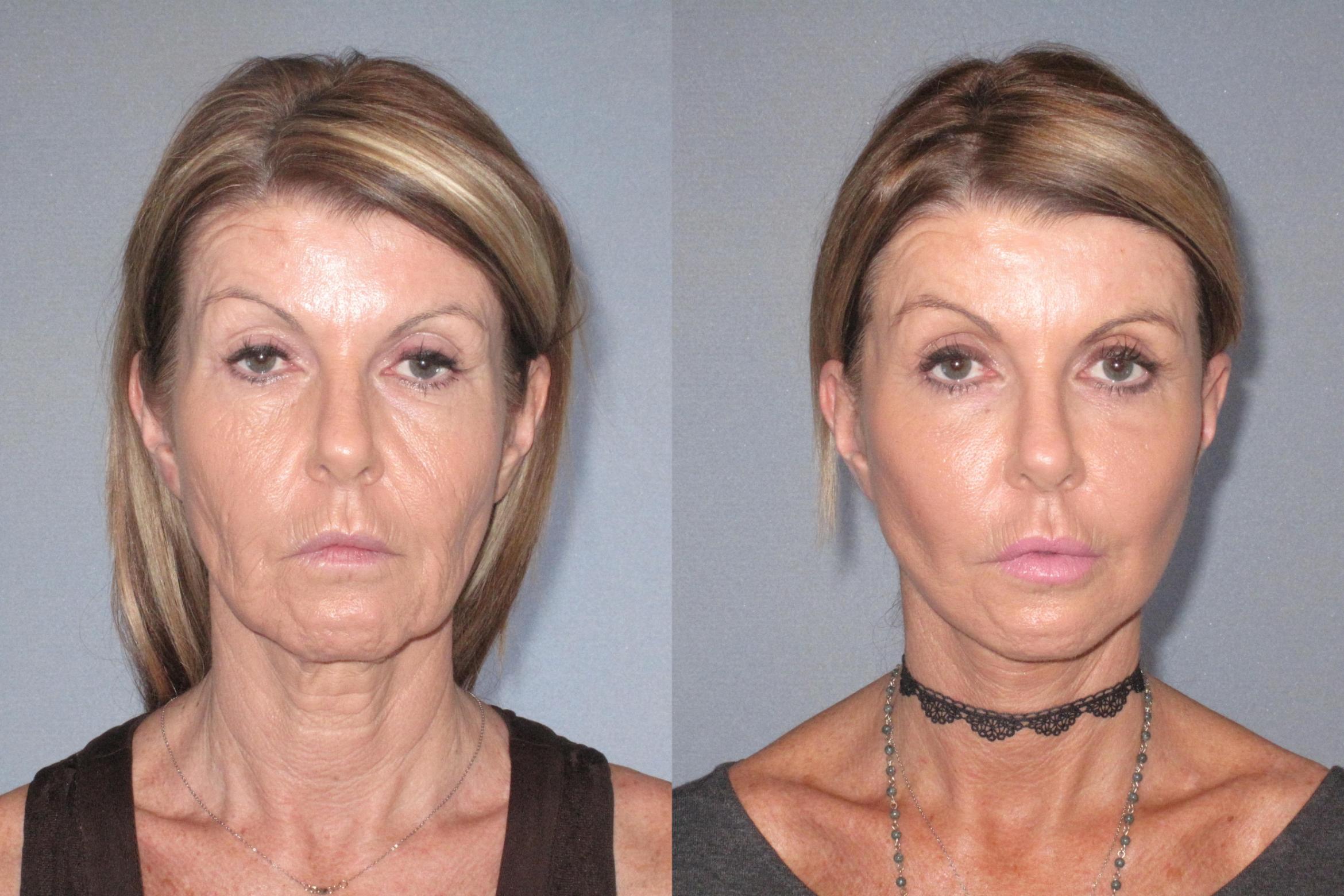 Before & After Neck Lift Case 18125 Front View in Houston, TX