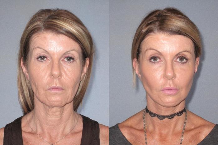 Before & After Neck Lift Case 18125 Front View in Houston, TX
