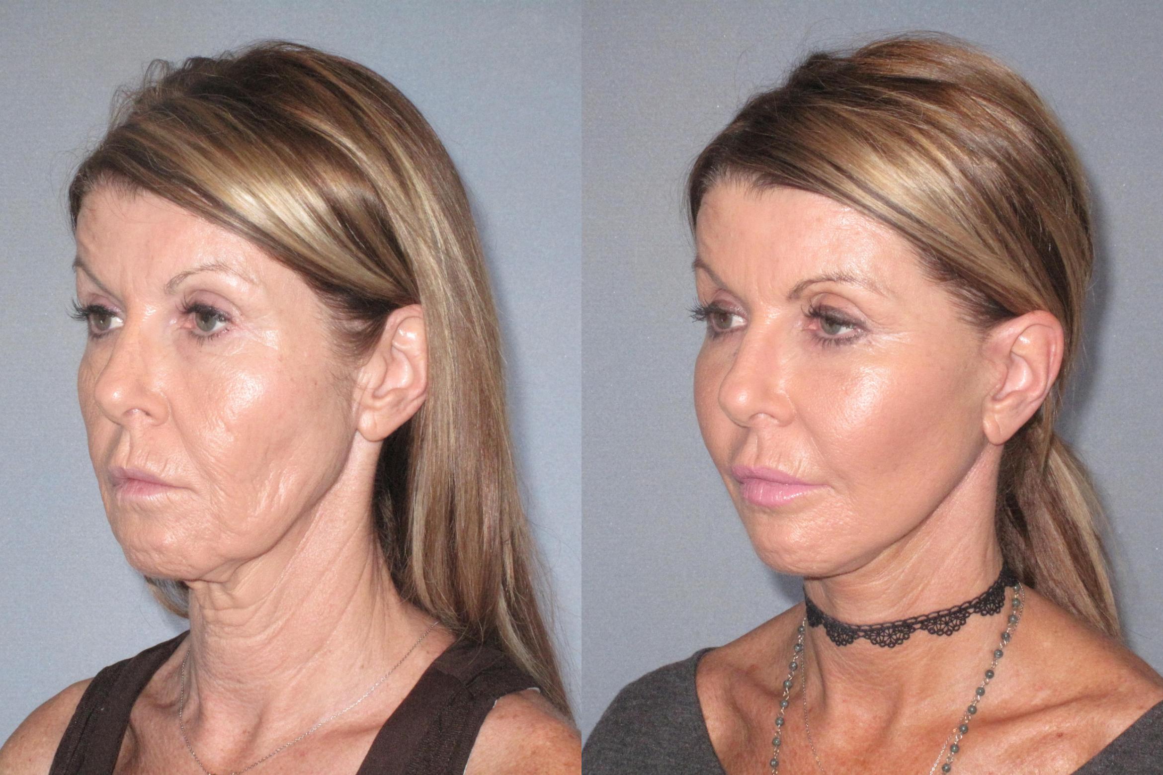 Before & After Neck Lift Case 18125 Left Oblique View in Houston, TX