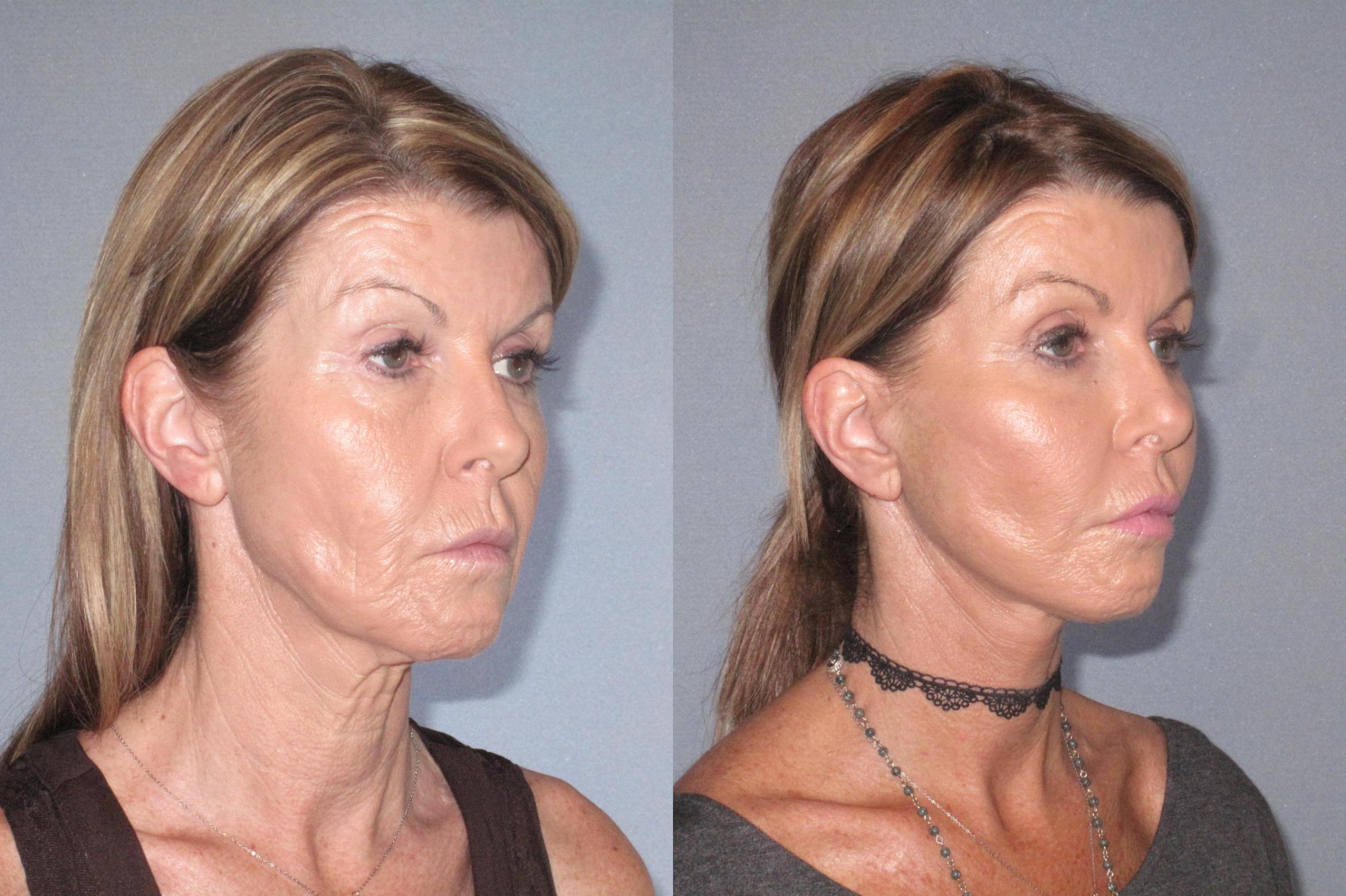 Before & After Neck Lift Case 18125 Right Oblique View in Houston, TX