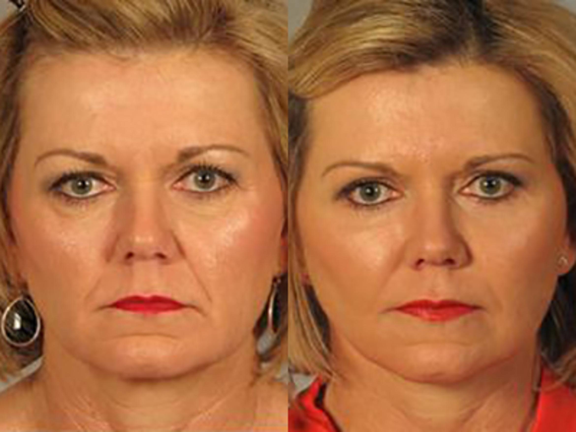 Before & After Facelift Case 5717 View 1 View in Houston, TX