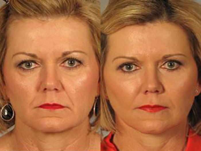 Before & After Facelift Case 5717 View 1 View in Houston, TX