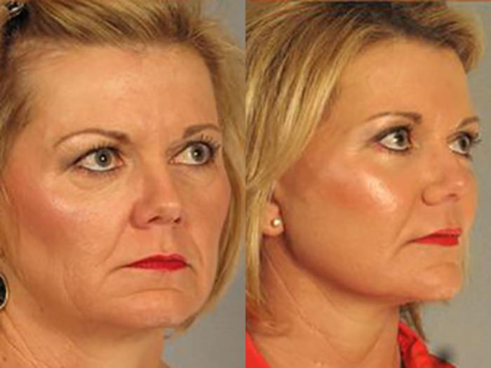 Before & After Facelift Case 5717 View 2 View in Houston, TX