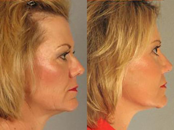 Before & After Facelift Case 5717 View 3 View in Houston, TX