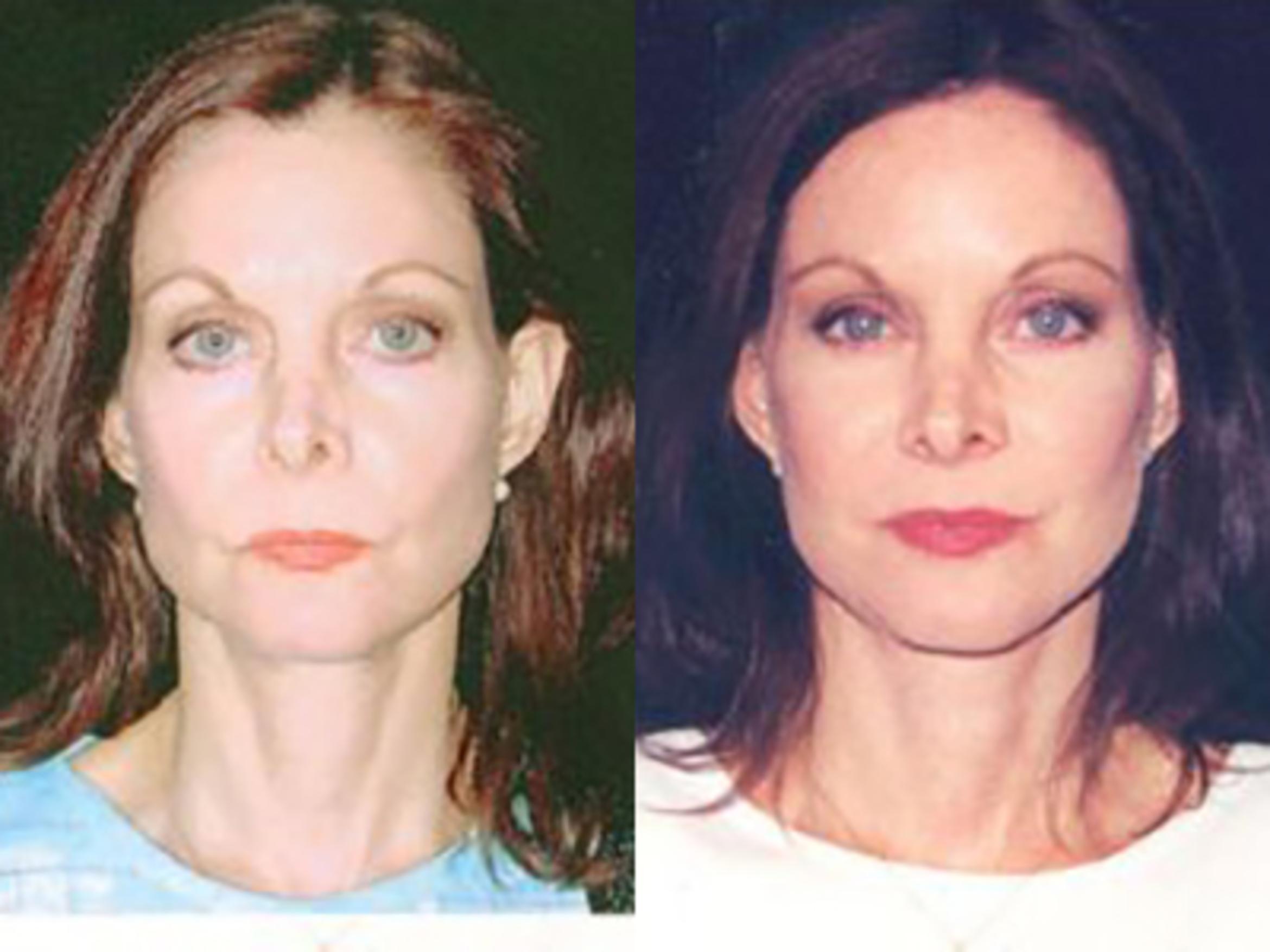 Before & After Facelift Case 5725 View 1 View in Houston, TX