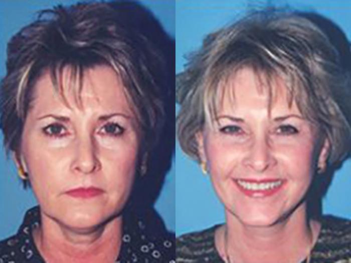 Before & After Facelift Case 5729 View 1 View in Houston, TX