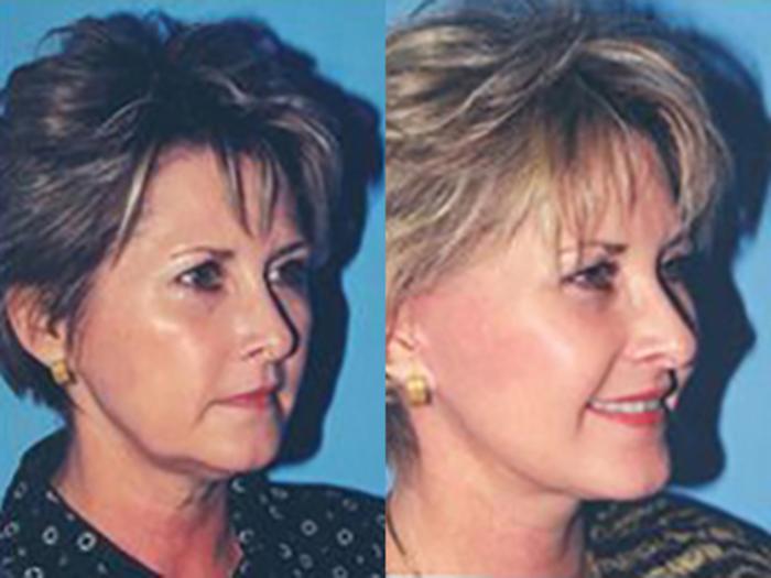 Before & After Facelift Case 5729 View 2 View in Houston, TX