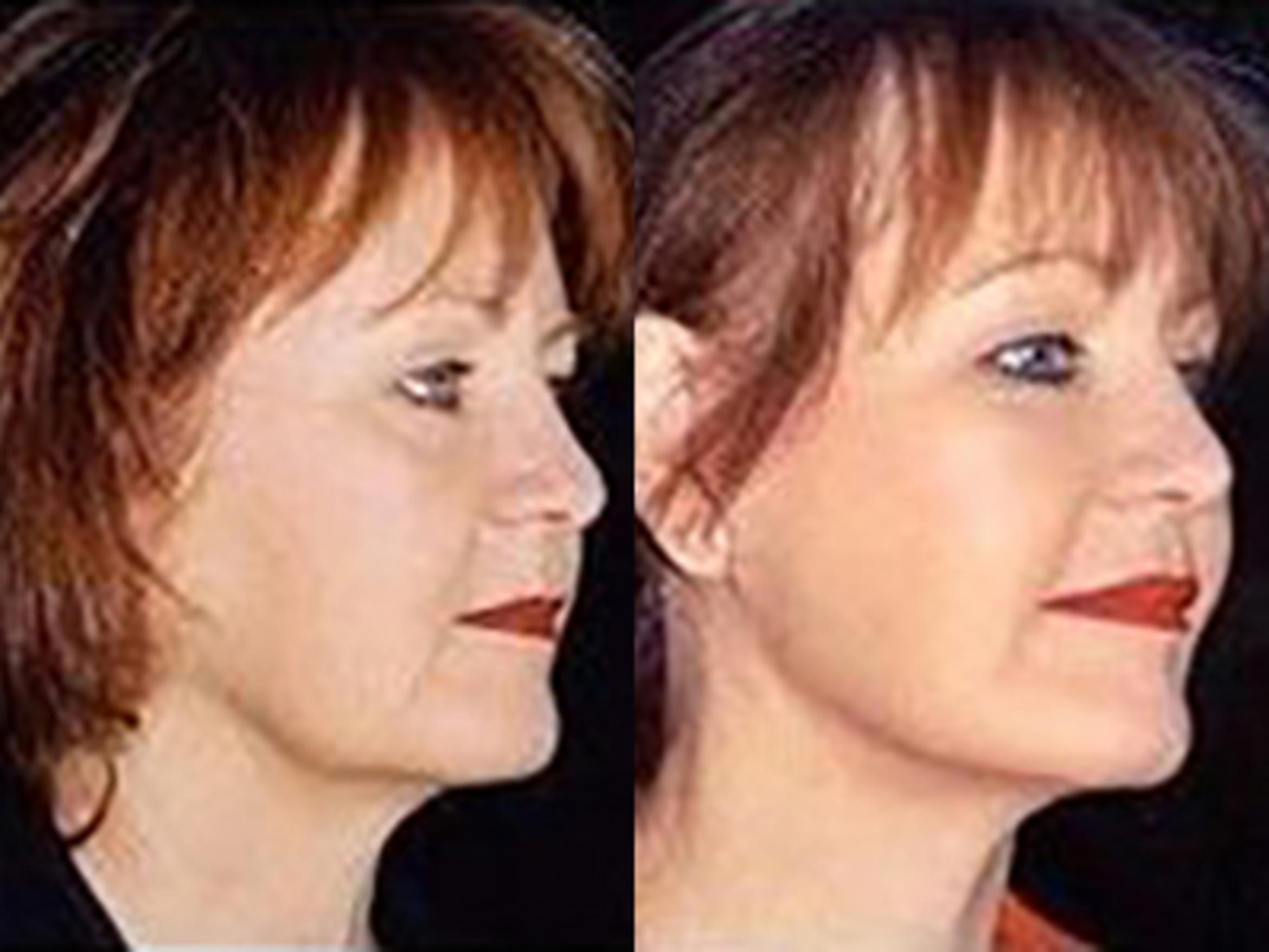 Before & After Facelift Case 5735 View 2 View in Houston, TX