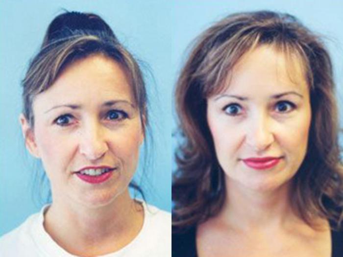 Before & After Facelift Case 5745 View 1 View in Houston, TX