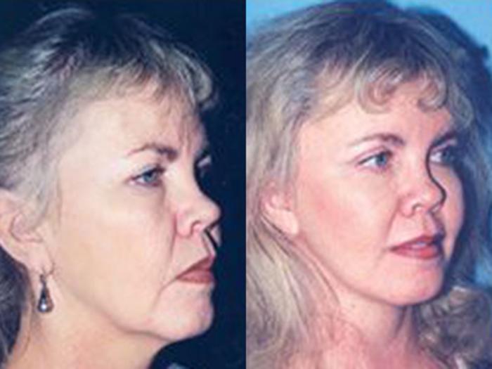 Before & After Facelift Case 5749 View 1 View in Houston, TX