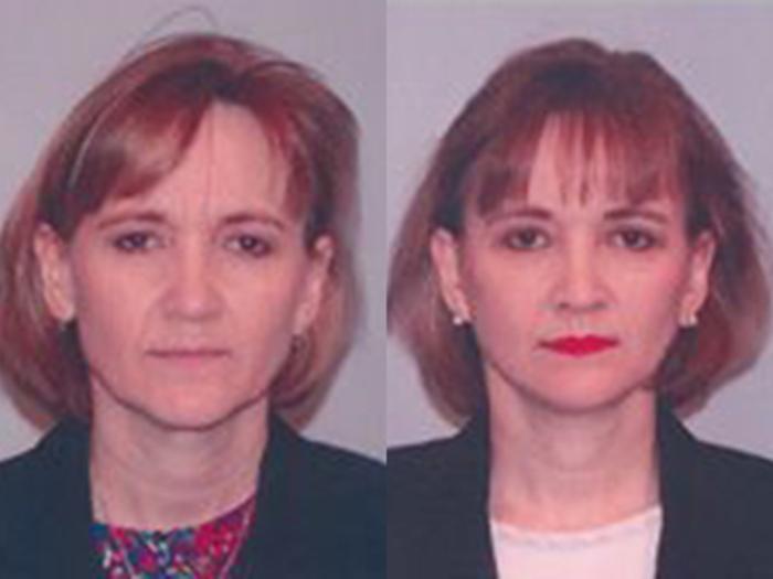 Before & After Facelift Case 5753 View 1 View in Houston, TX