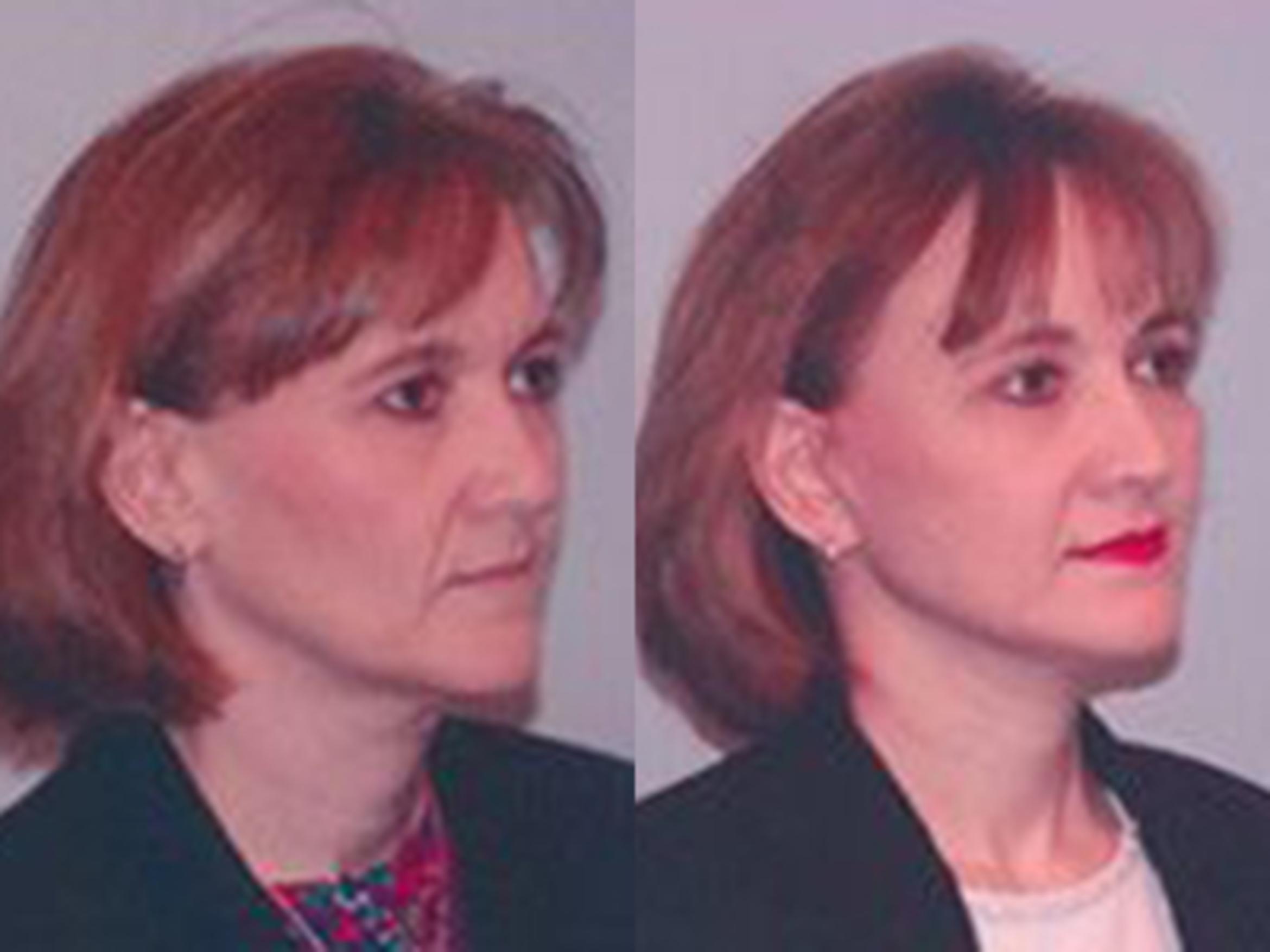 Before & After Facelift Case 5753 View 2 View in Houston, TX