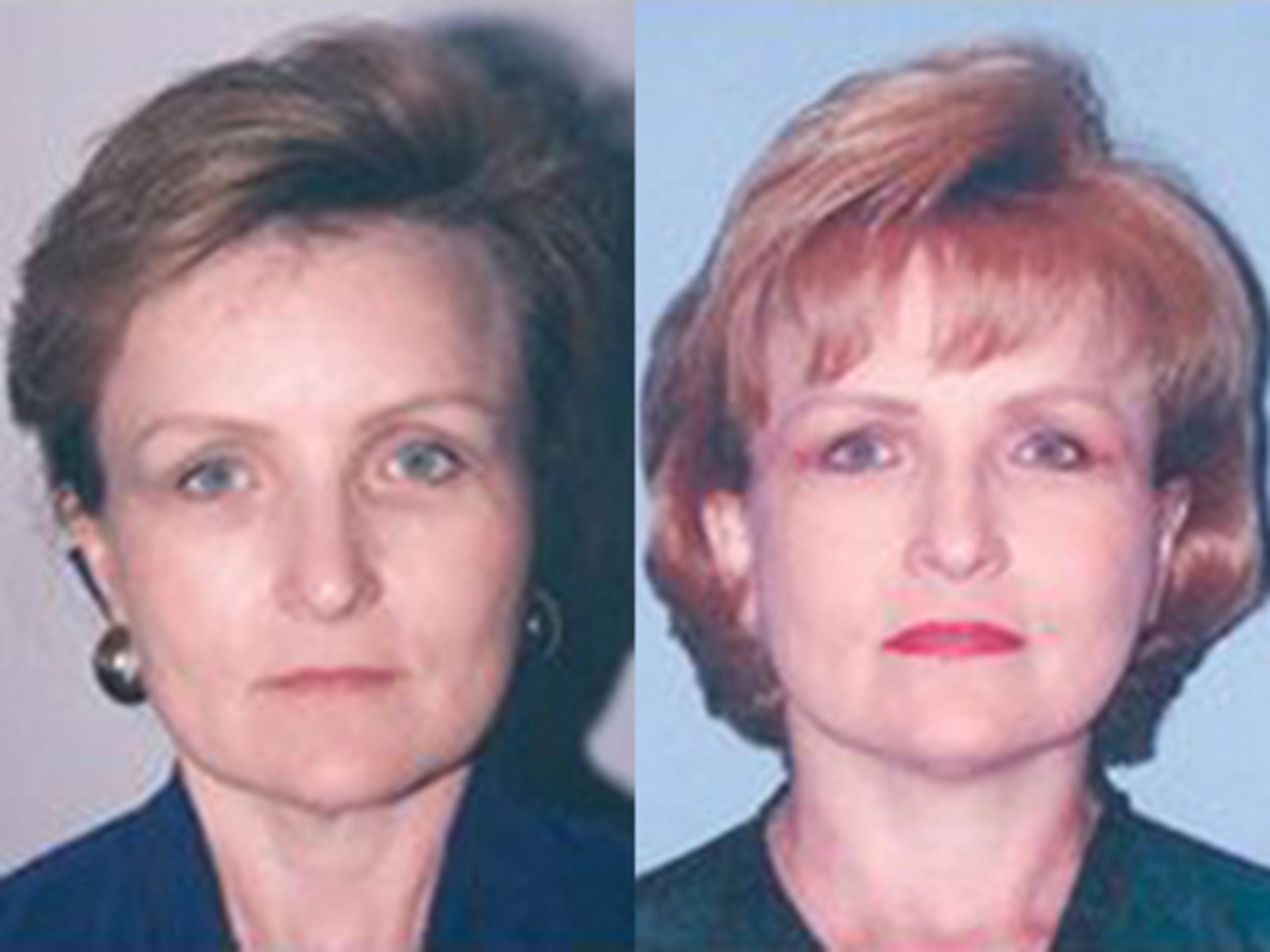 Before & After Facelift Case 5763 View 1 View in Houston, TX