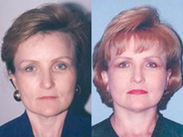 Before & After Facelift Case 5763 View 1 View in Houston, TX