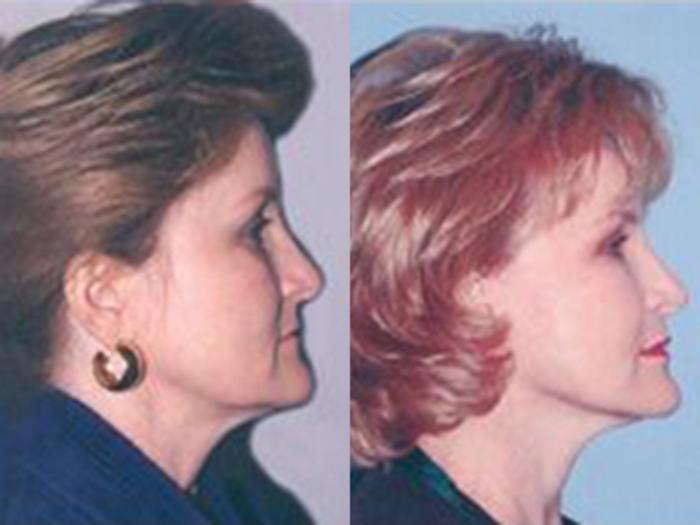 Before & After Facelift Case 5763 View 2 View in Houston, TX