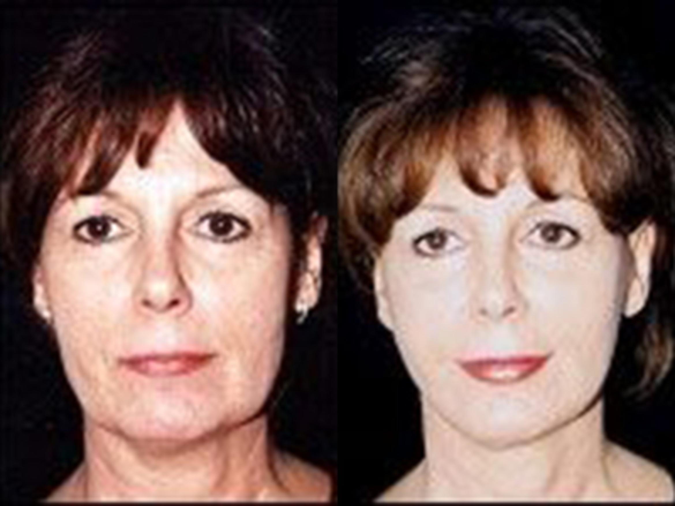 Before & After Facelift Case 5773 View 1 View in Houston, TX