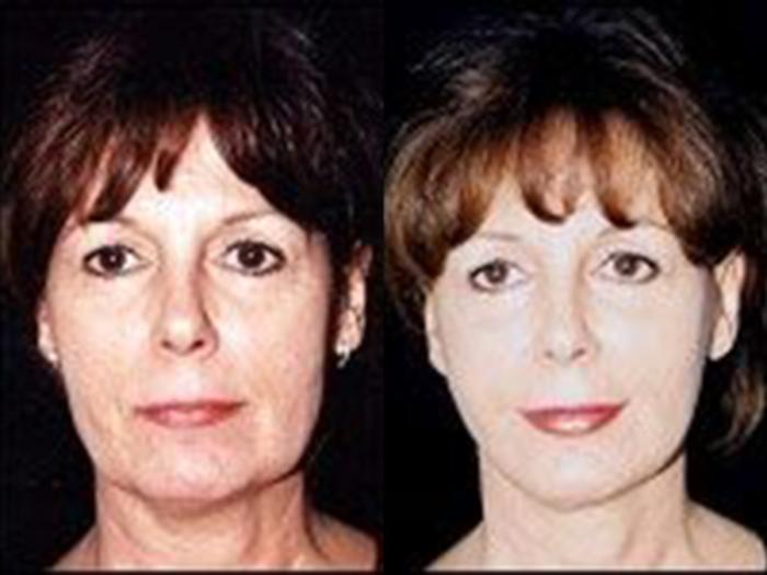 Before & After Facelift Case 5773 View 1 View in Houston, TX