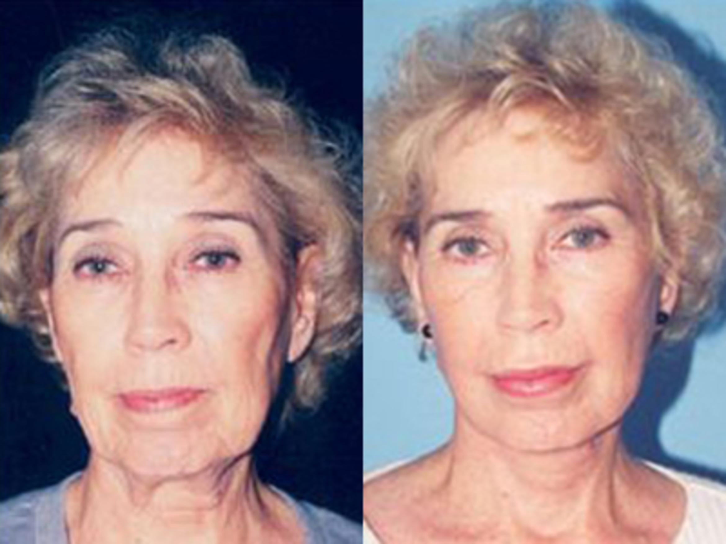 Before & After Facelift Case 5781 View 1 View in Houston, TX