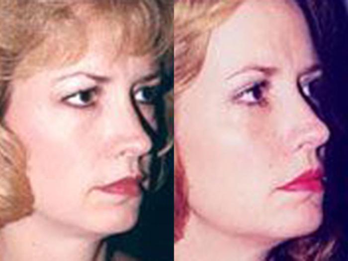 Before & After Facelift Case 5789 View 1 View in Houston, TX