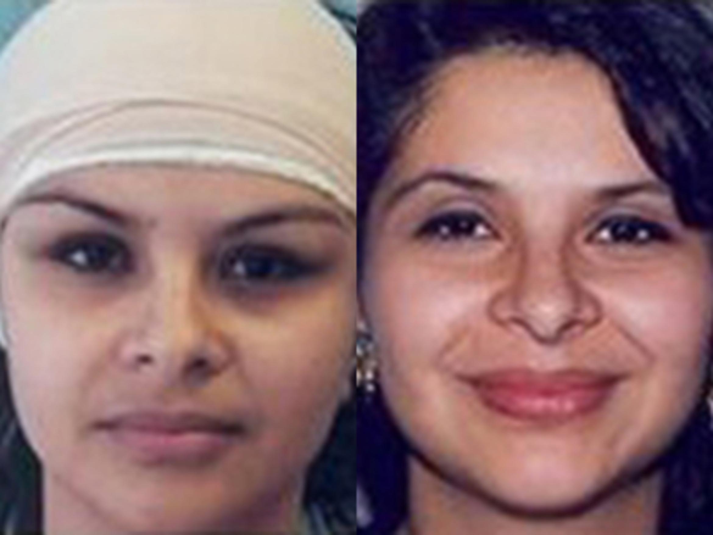 Before & After Facelift Case 5793 View 1 View in Houston, TX