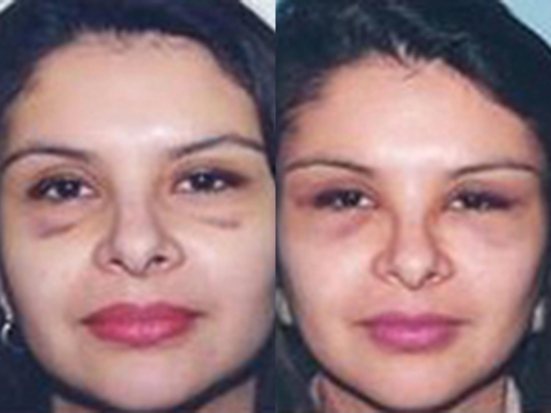 Before & After Facelift Case 5793 View 2 View in Houston, TX