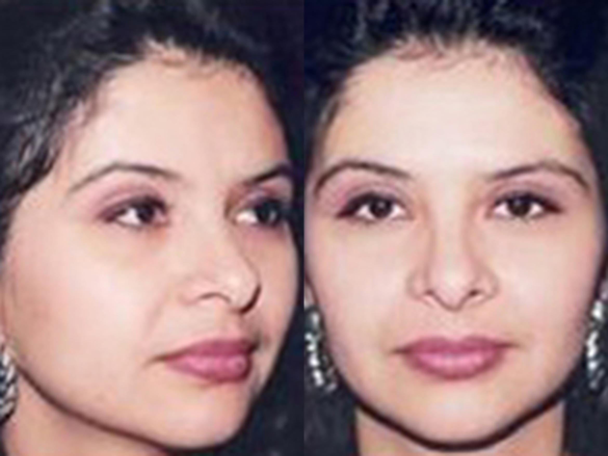 Before & After Facelift Case 5793 View 3 View in Houston, TX