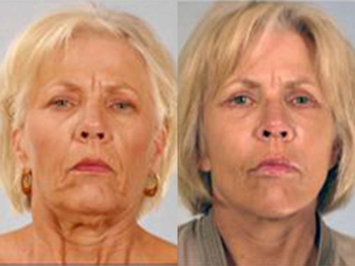 Before & After Facelift Case 5813 View 1 View in Houston, TX